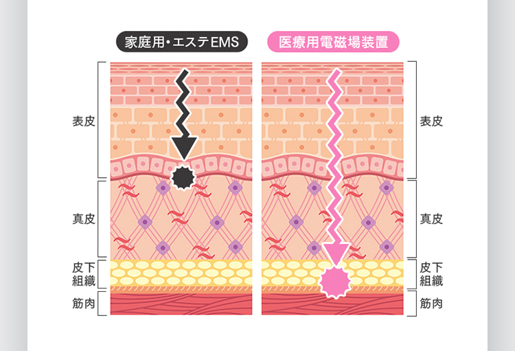 家庭用・エステEMS