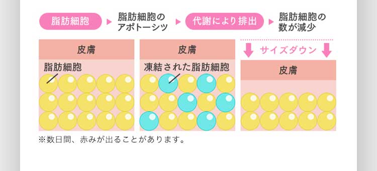 脂肪細胞 脂肪細胞のアポトーシツ 代謝により排出 脂肪細胞の数が減少 ※数日間、赤みが出ることがあります。